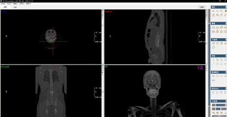 DCTViewer 開啟醫學三維分析新視界