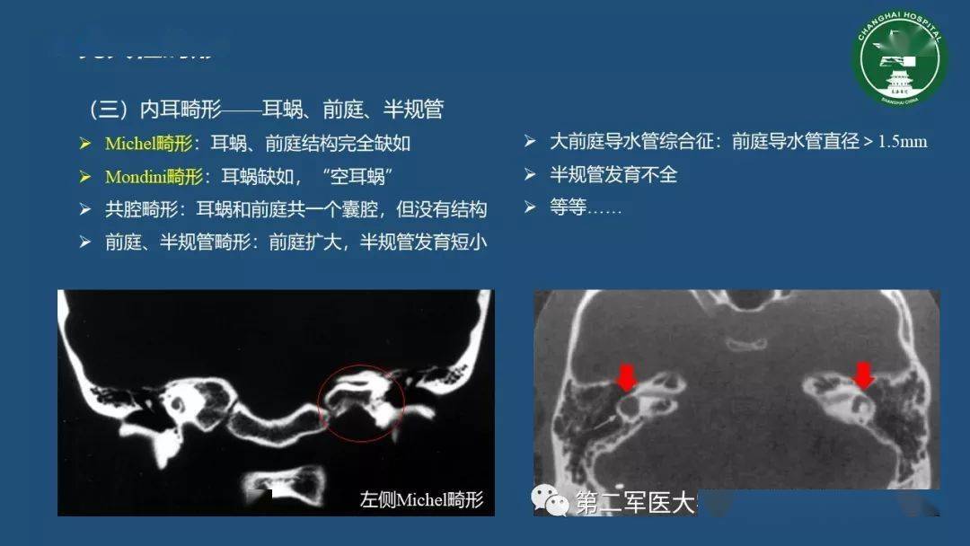 顳骨斷層解剖與CT三維重建 醫學三維分析的臨床價值
